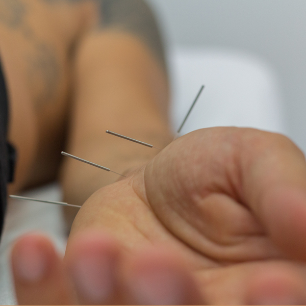 Acupuncture in Chania