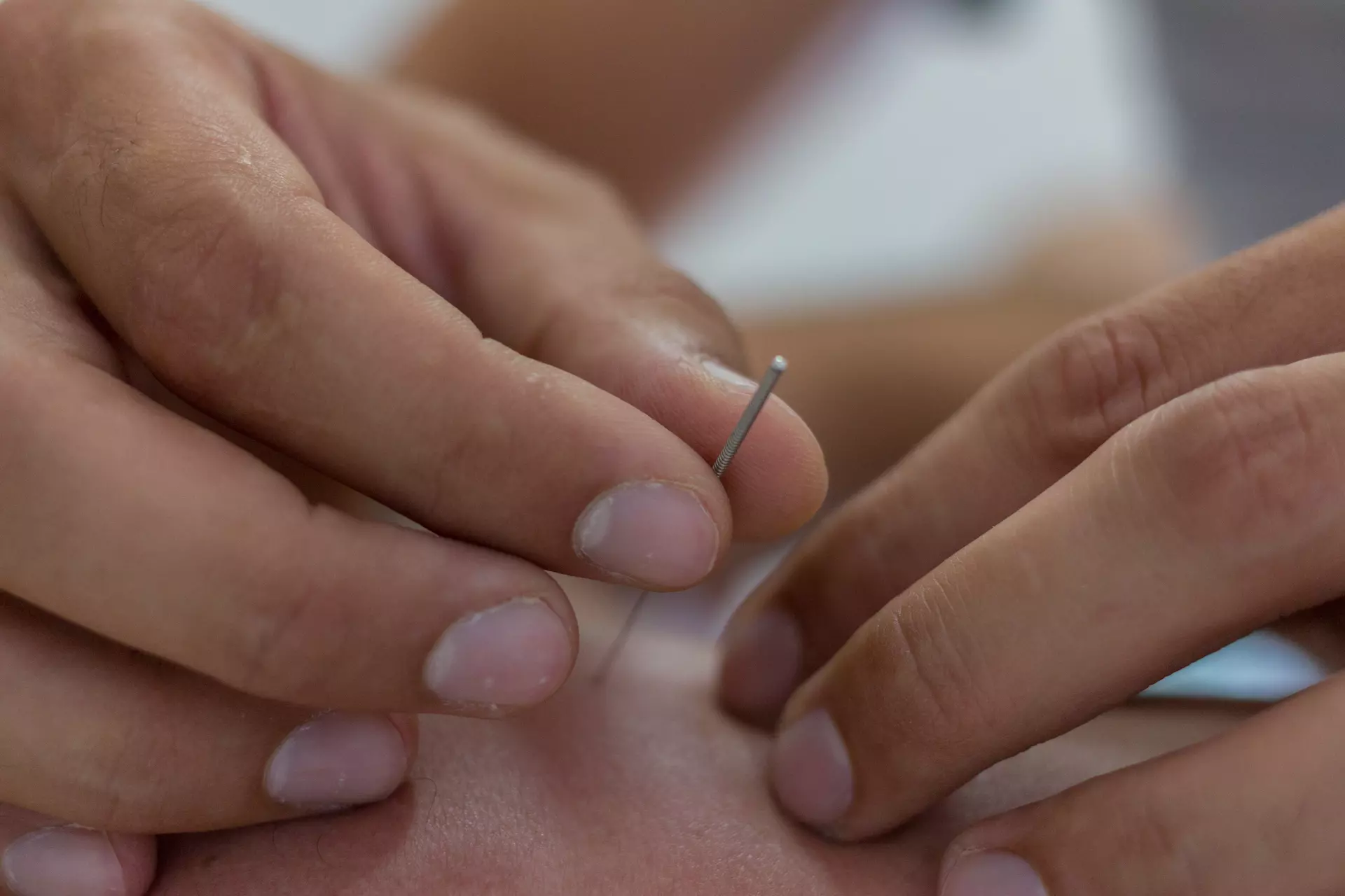 acupuncture in Chania - Physiotherapy and Trigger Point in Chania Crete