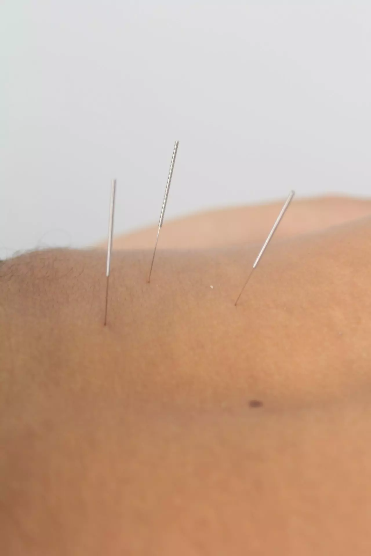 acupuncture in Chania - Physiotherapy and Trigger Point in Chania Crete