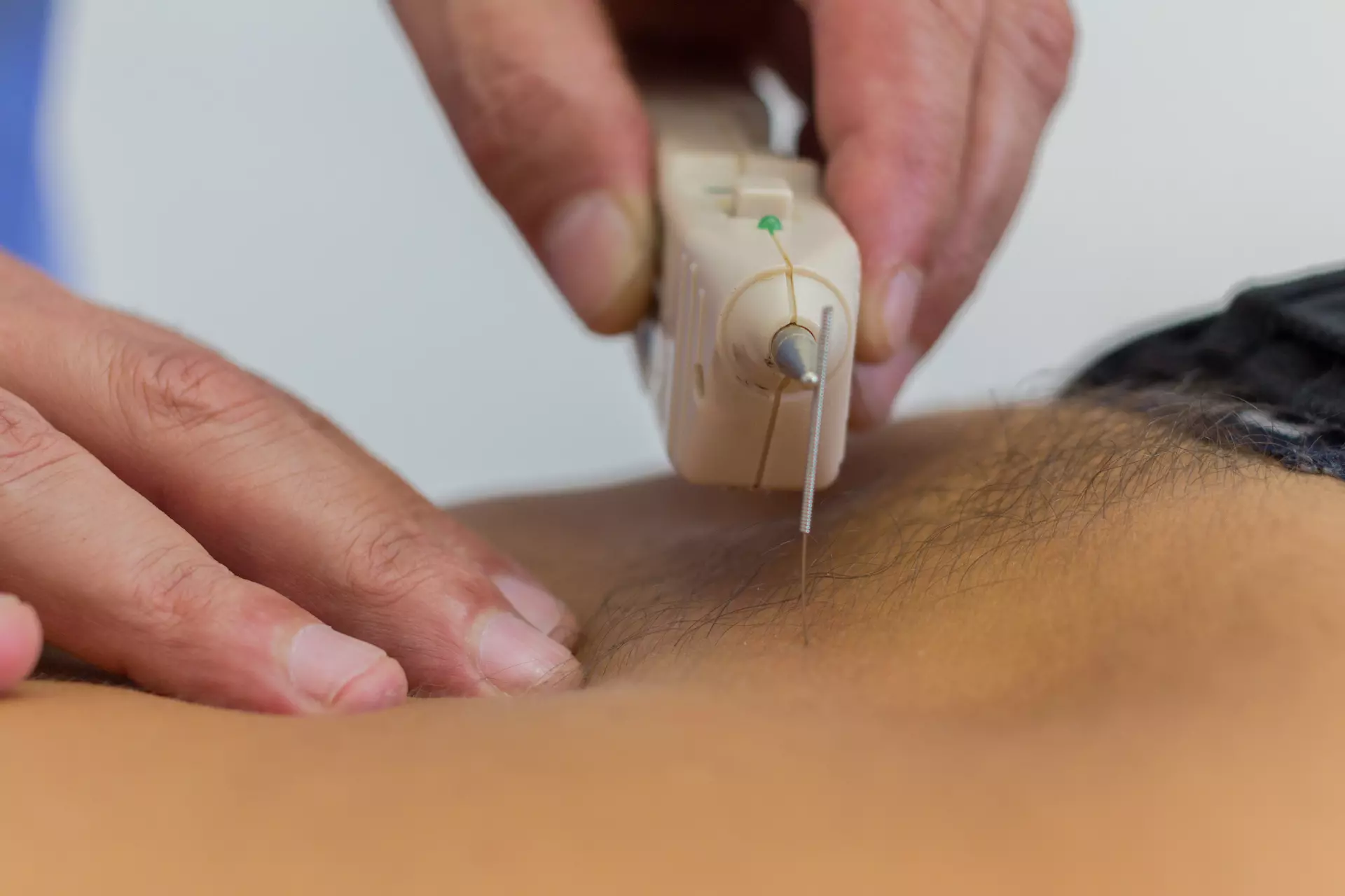 chania acupuncture and intramuscular stimulation - chania physiotherapy clinic
