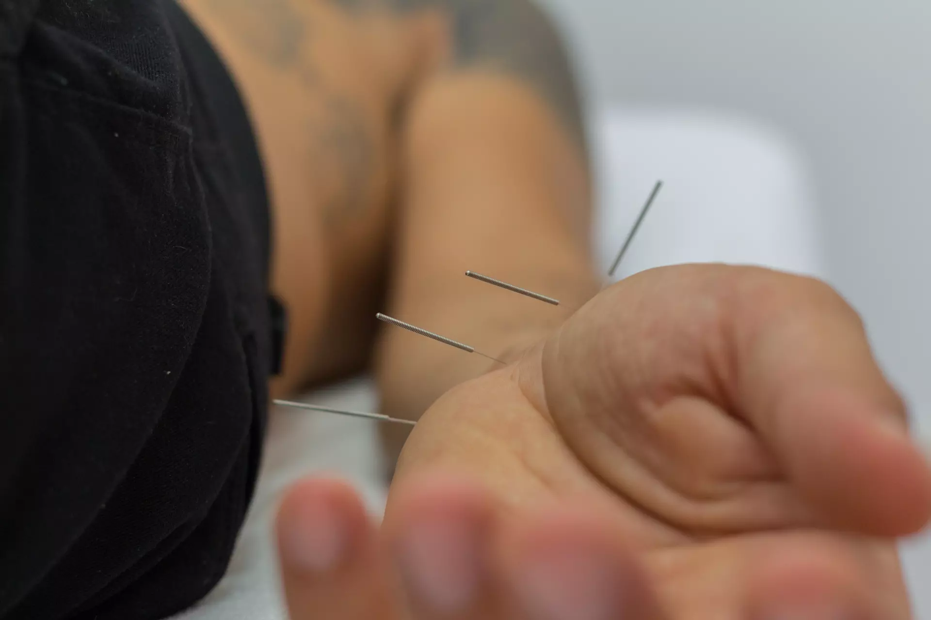 Medical Acupuncture in Chania Crete - Chania Physiotherapy Clinic