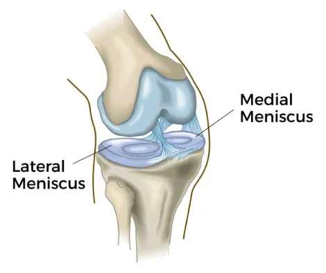 Meniscal tear: Can it be treated without surgery?